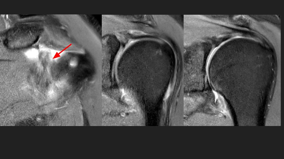 Figure 3 for case adhesive capsulitis